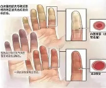 【健康科普】冬日里的“变色手指”：认识雷诺现象